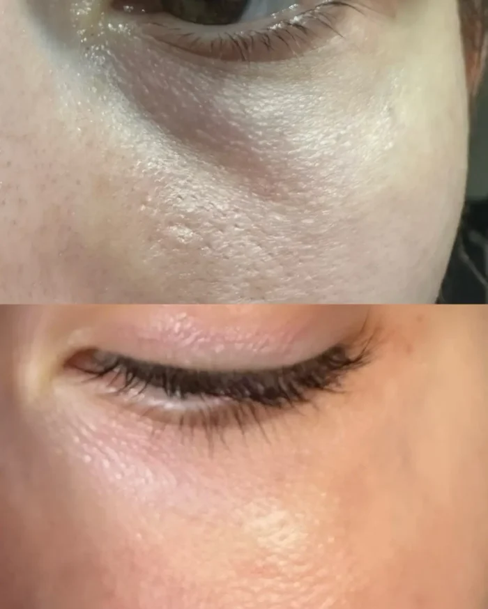 Anti-aging-tretman-pre-i-posle-300x300