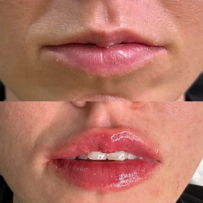 Anti-aging-tretman-pre-i-posle-300x300