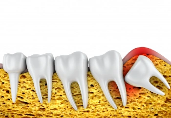 vadjenje-umnjaka-web