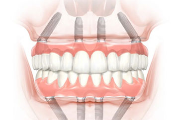 vadjenje-umnjaka-web