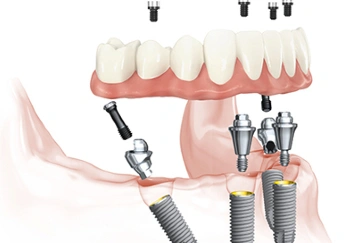 ilustracija-zubnih-implantata-donje-vilice